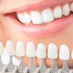 Why Aesthetic Dental Wellness is Essential for a Confident Smile